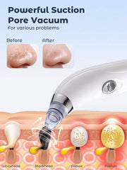 Blackhead Vacuum Remover, Powerful Portable Facial Pore Cleaner With 4 Probes, Remove Blackhead In Gentle And Way Without Squeezing Pain For Women And Men. Your Personal Professional Beautician.